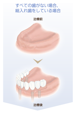 逗子・鎌倉・葉山のインプラント治療の適用例3｜すべての歯がない場合、総入れ歯をしている場合 